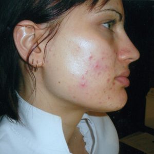 amanda bailey pimple treatment with laser north melbourne