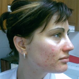 amanda acne south melbourne