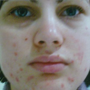 amanda bailey start of acne