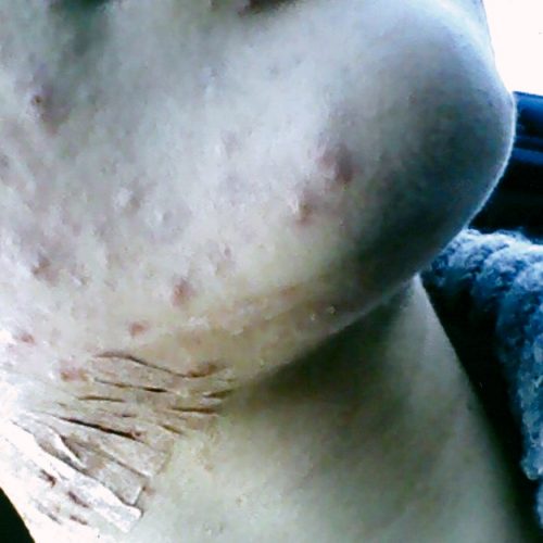 amanda bailey acne for surgery
