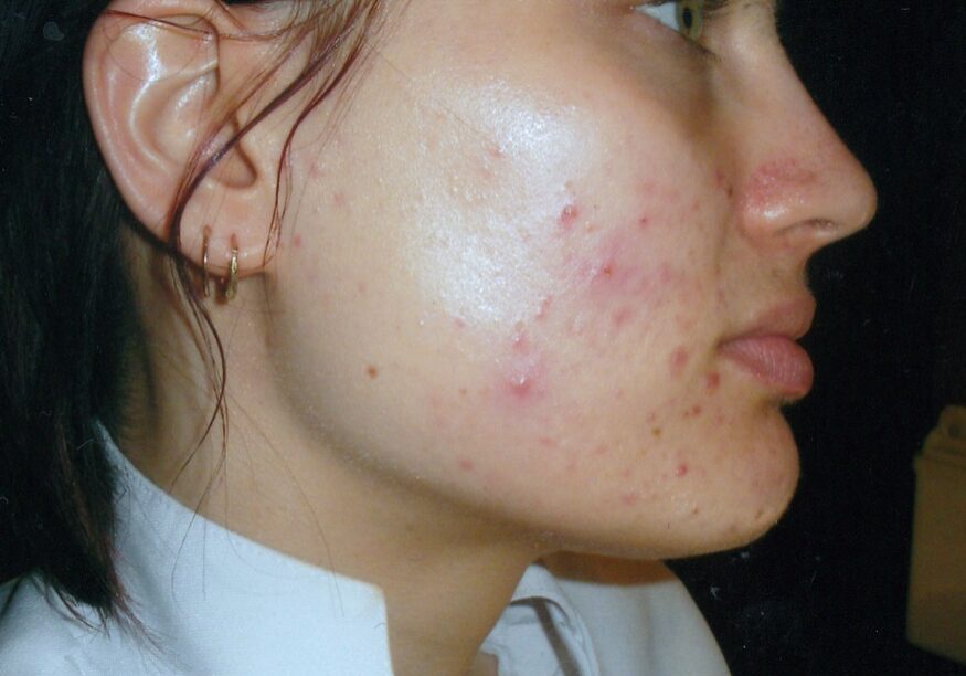 amanda bailey pimple treatment with laser north melbourne